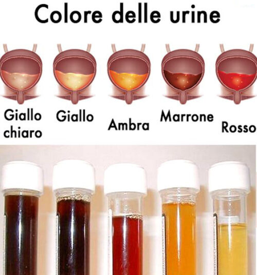 Emazie nelle urine: che cosa significa? Cause, diagnosi e trattamenti